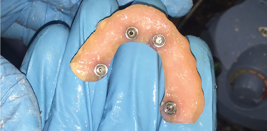 All-on-4 Clinical Procedure (WARNING GRAPHIC IMAGES) - Iverson Dental Labs