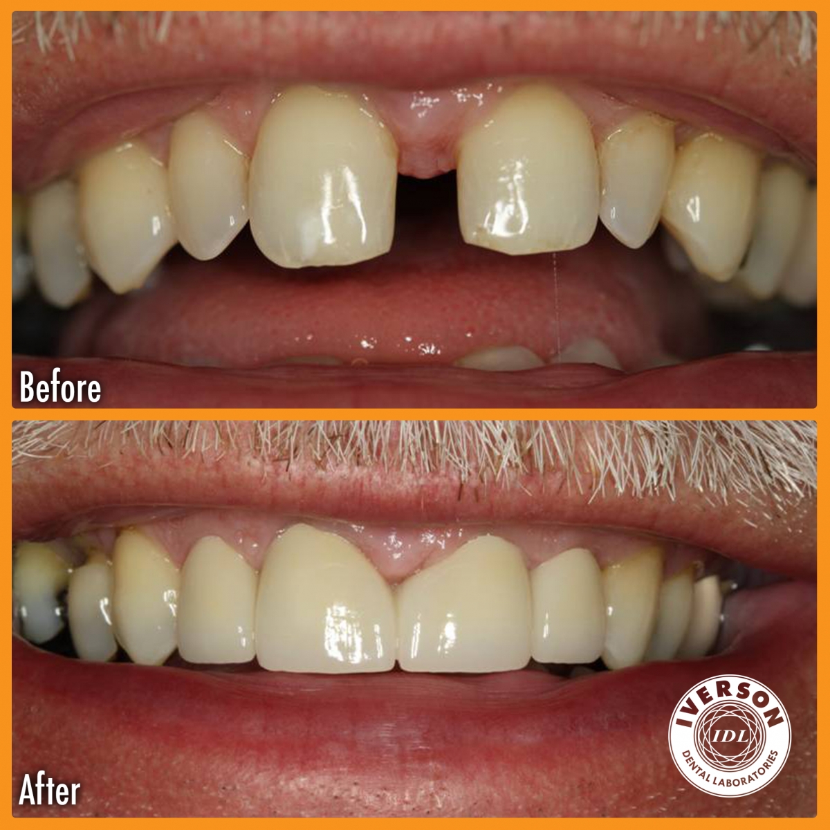 iverson dental labs dental crowns create before and after smiles Iverson Dental Labs