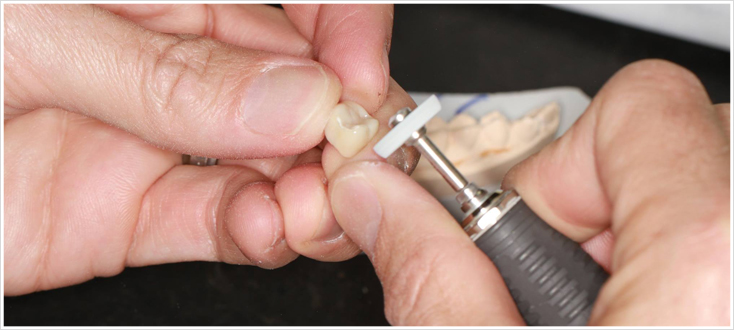 career in dental technology Porcelain Fused to Zirconia