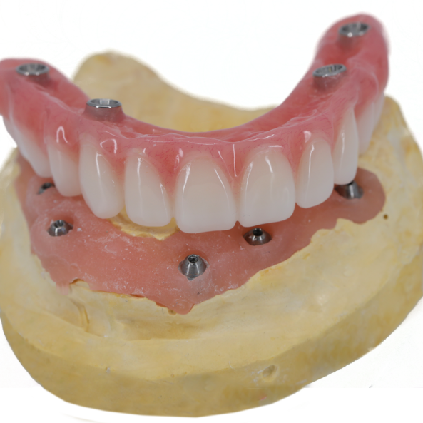 all on 4 denture implant
