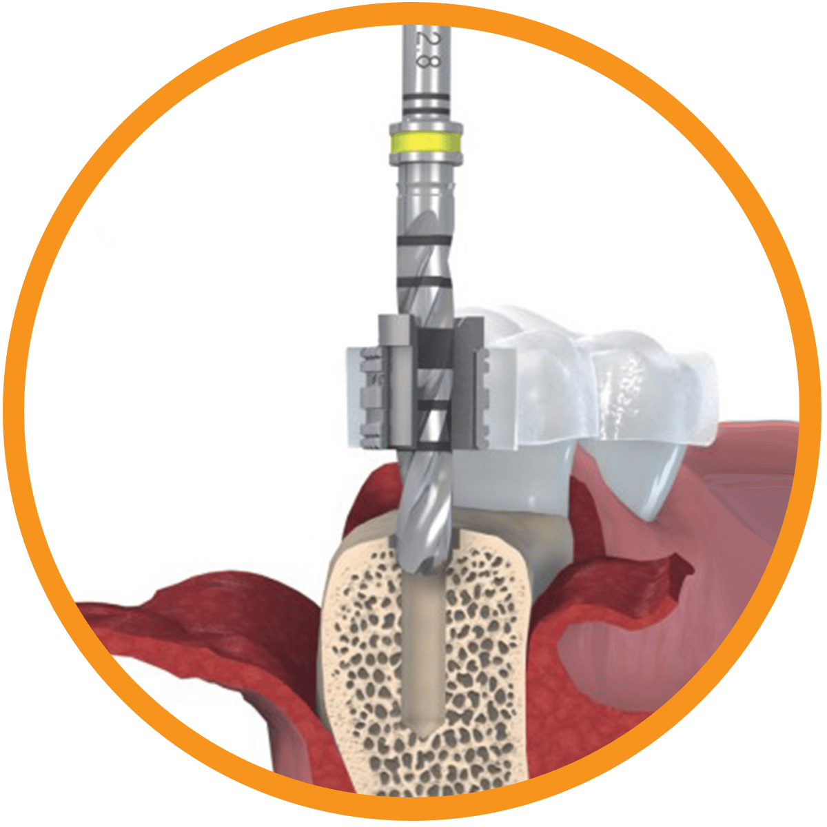 accuguide Guided surgery and implant insertion